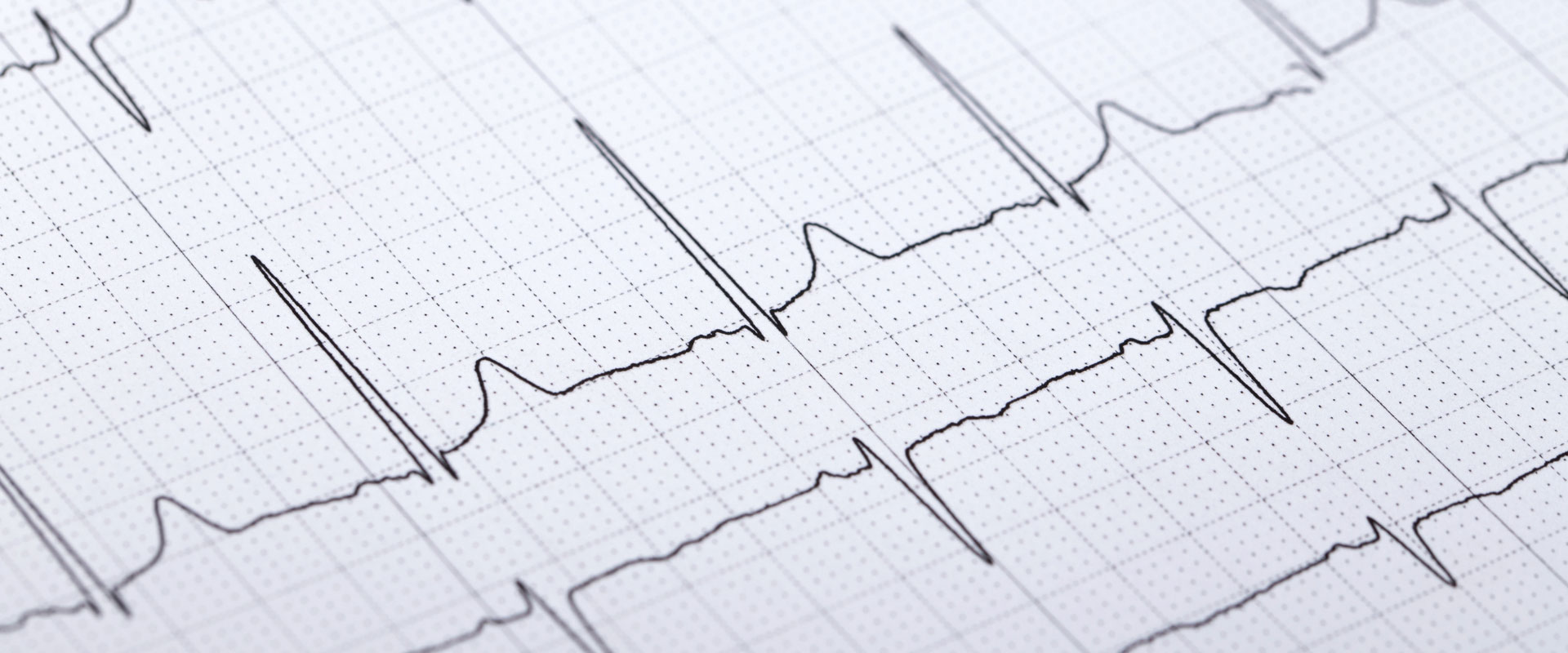 EKG